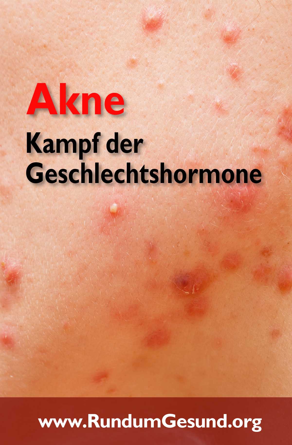 Akne - Kampf der Geschlechtshormone